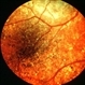 Widespread pigment changes